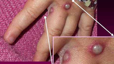 Случаи оспы обезьян — «всего лишь верхушка айсберга» — ВОЗ — RT World News