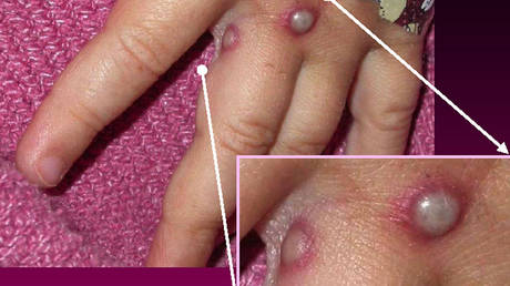 В США подтвержден первый случай редкого заболевания, распространившегося в Европе — RT World News