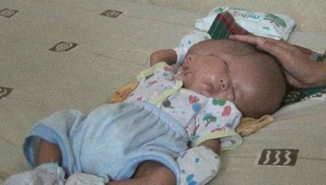 В Индонезии родился ребенок с 2 лицами