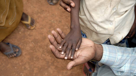 Рекордный уровень детского голода зафиксирован на Африканском Роге