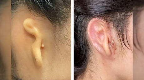 Женщине сделали пересадку уха на 3D-принтере