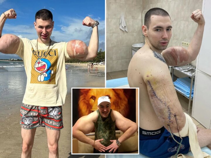 Цена мутации: «Русский Попай» может лишиться рук из-за инъекций синтола